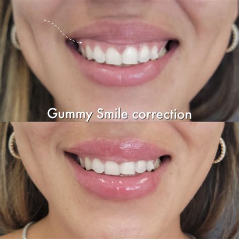 how to remove gummy smile.